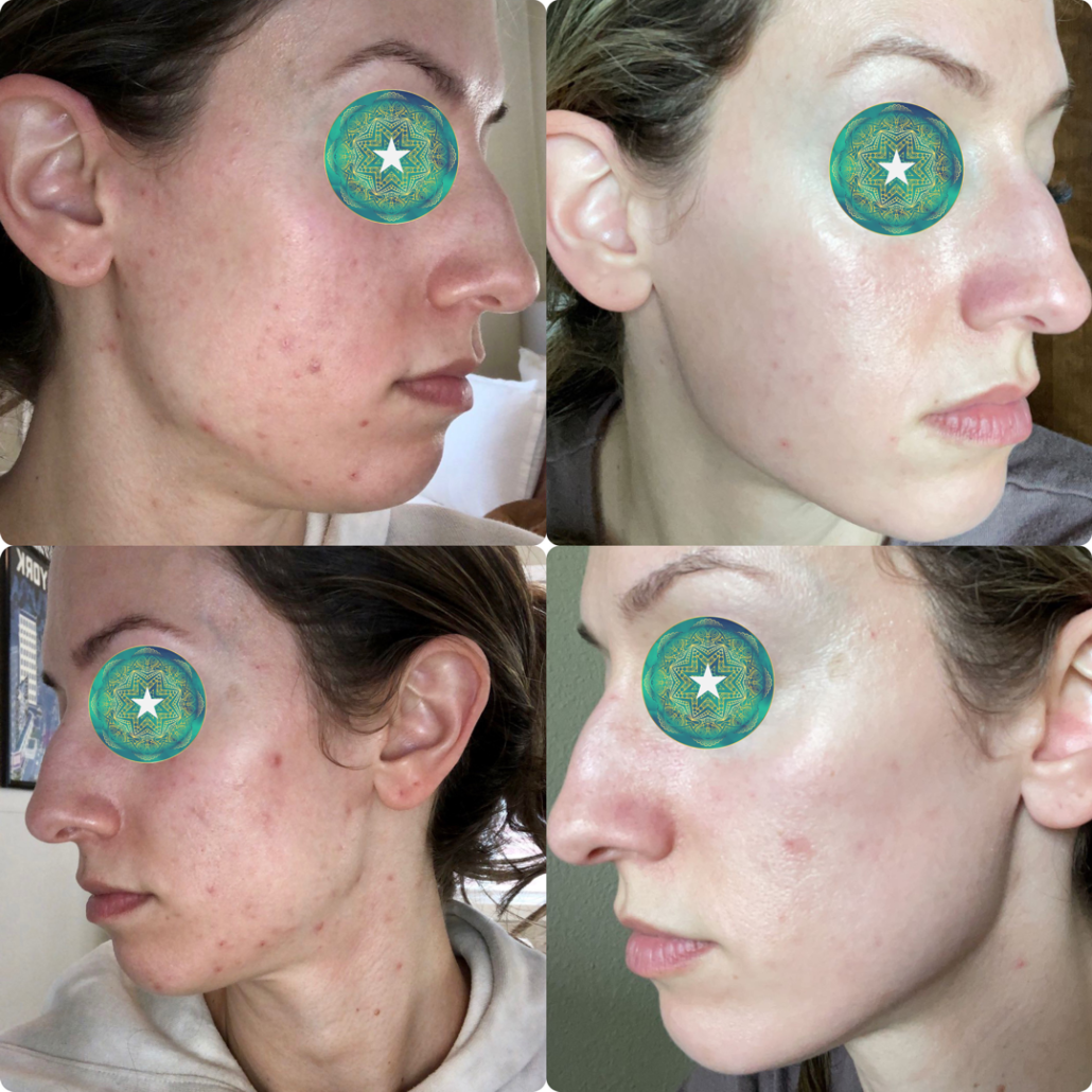 Acne Before and After Pictures - Clear Skin America, Beaverton, OR